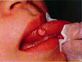 腫瘍1